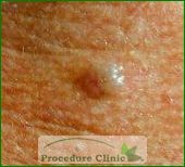 skin cancer